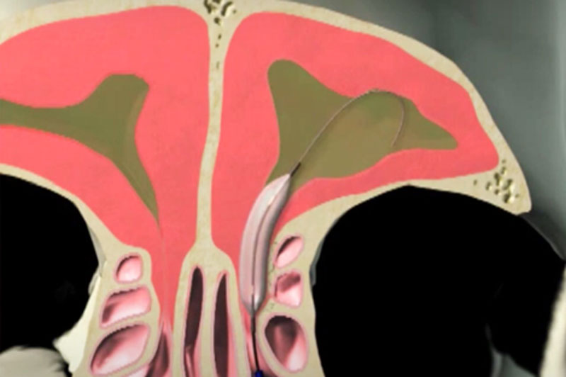 Illustration of sinus cavity with the balloon scope inserted